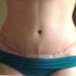 Photos of tummy tuck recovery in 8 months