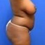 Photos of tummy tuck see online
