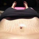 Photos of tummy tuck stretch marks pic