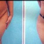 Tummy tuck belly button pictures Austin surgeons pictures