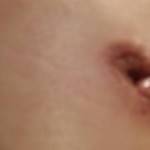 Tummy tuck belly button pictures Austin top plastic surgeons pictures