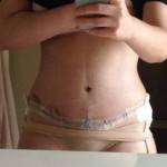 Tummy tuck belly button pictures Dallas plastic surgeons images