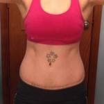 Tummy tuck belly button pictures Dallas top best surgeons