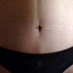 Tummy tuck belly button pictures Florida top plastic surgeons images
