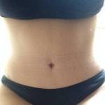 Tummy tuck belly button pictures Houston top best cosmetic surgeons shapshots