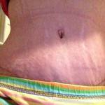 Tummy tuck belly button pictures Miami top best cosmetic surgeons shapshots