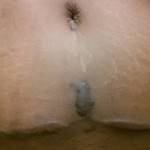Tummy tuck belly button pictures Tampa top best plastic surgeons pictures