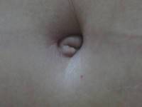 Tummy tuck belly button pictures after before picture