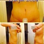 Tummy tuck belly button pictures after birth pictures