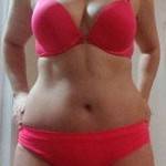 Tummy tuck belly button pictures and lipo operation images
