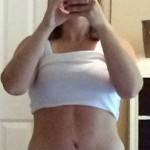 Tummy tuck belly button pictures and lipo operation pictures