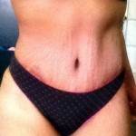 Tummy tuck belly button pictures and lipo surgery image