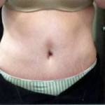 Tummy tuck belly button pictures belly button pictures