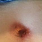 Tummy tuck belly button pictures lipo photo