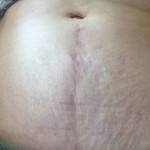 Tummy tuck belly button pictures lipo procedure photos