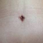 Tummy tuck belly button pictures of non surgical pictures