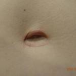 Tummy tuck belly button pictures of post op images
