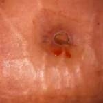 Tummy tuck belly button pictures of scar treatment photo