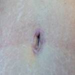 Tummy tuck belly button pictures with or without liposuction