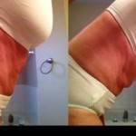Tummy tuck photos before and after Atlanta GA top best cosmetic surgeons pics