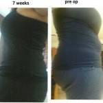 Abdominoplasty vs tummy tuck Charlotte nc top best plastic surgeons pics