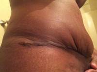 Abdominoplasty vs tummy tuck scar