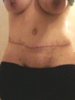Recovery time scar tummy tuck surgery