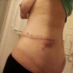 Recovery time tummy tuck surgery in 1 month