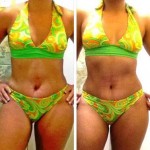 Recovery time tummy tuck surgery photos