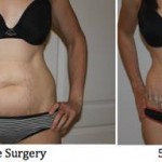 Standard tummy tuck pictures Florida best cosmetic surgeons