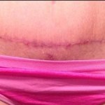 Standard tummy tuck pictures with liposuction surgery photo