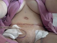 The Recovery time tummy tuck surgery operation