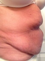 Tummy tuck after twins pregnancy images