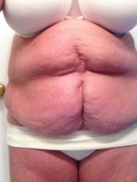 Tummy tuck after twins pregnancy pictures