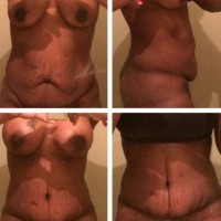 Before and after tummy tuck very low incision photo