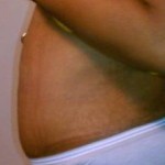 Image of candidate for a surgery tummy tuck