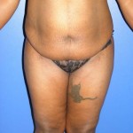 Image of candidate for a tummy tuck abdominoplasty
