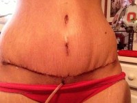Photo of tummy tuck cosmetic tourism