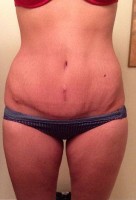 Pic of abdominoplasty low incision  surgery image