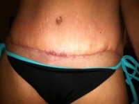 Quilting sutures after tummy tuck