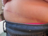 Quilting sutures after tummy tuck surgery