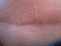 The quilting sutures after tummy tuck operation