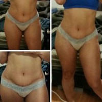 Tummy tuck out of US medical tourism picture
