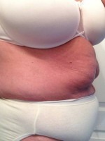What should I do first Abdominoplasty, lipo or brazilian butt lift