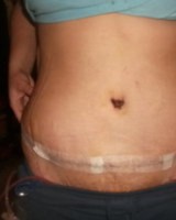 Tummy Tuck incisions are critically important