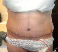 place the tummy tuck scar very low