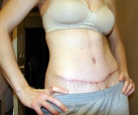 A tummy tuck is possible in a diabetic