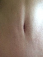 The belly button is not always relocated after abdominoplasty