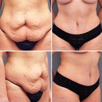 Before And After DrainLess Abdominoplasty