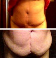 Doctor Mark Edinburg Before And AfterTummy Tuck